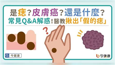 身體多痣|是痣？皮膚癌？還是什麼？常見Q&A解惑！醫教揪出「。